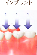 インプラント