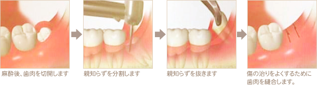 親知らずの抜歯方法