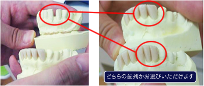 どちらの歯列かお選びいただけます